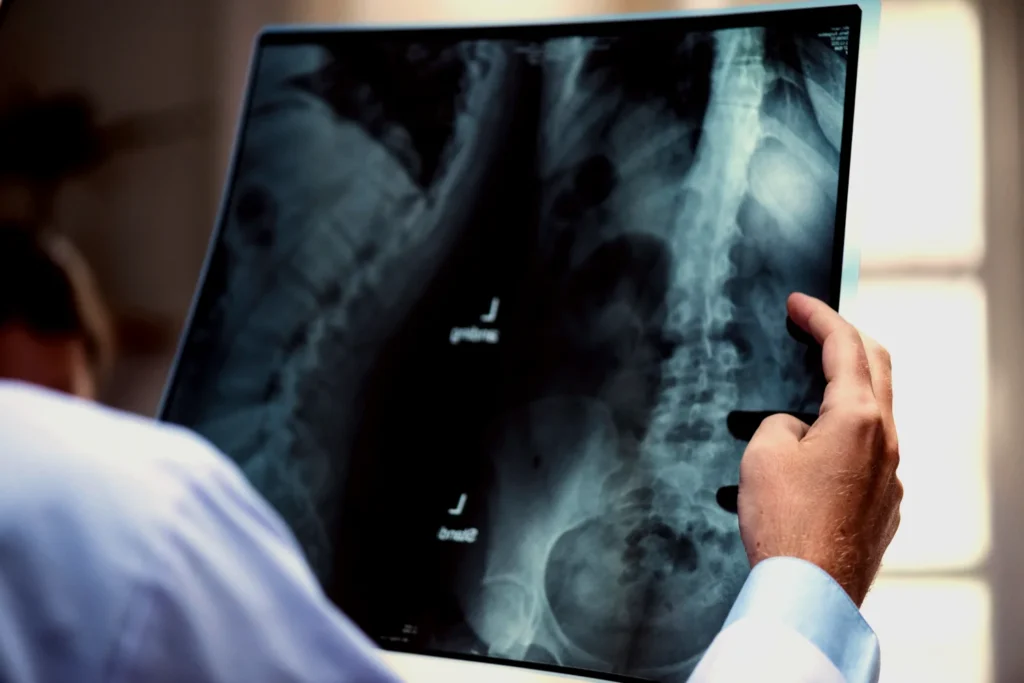 A doctor examining an X-ray of a spine which indicates a spinal injury, and the doctor is holding it up for detailed observation